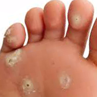 Verrucae Treatments