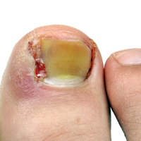 Ingrown Toe Nails